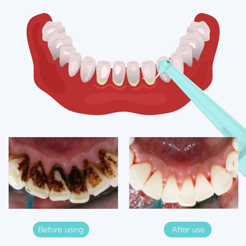 Pink Hlpmedical high-frequency vibration dental calculus and stain remover for oral care, designed to clean teeth effectively.