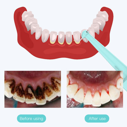 Pink Hlpmedical high-frequency vibration dental calculus and stain remover for oral care, designed to clean teeth effectively.